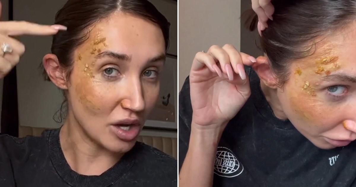 Towie star Megan McKenna's face and ear covered in burns in horror accident